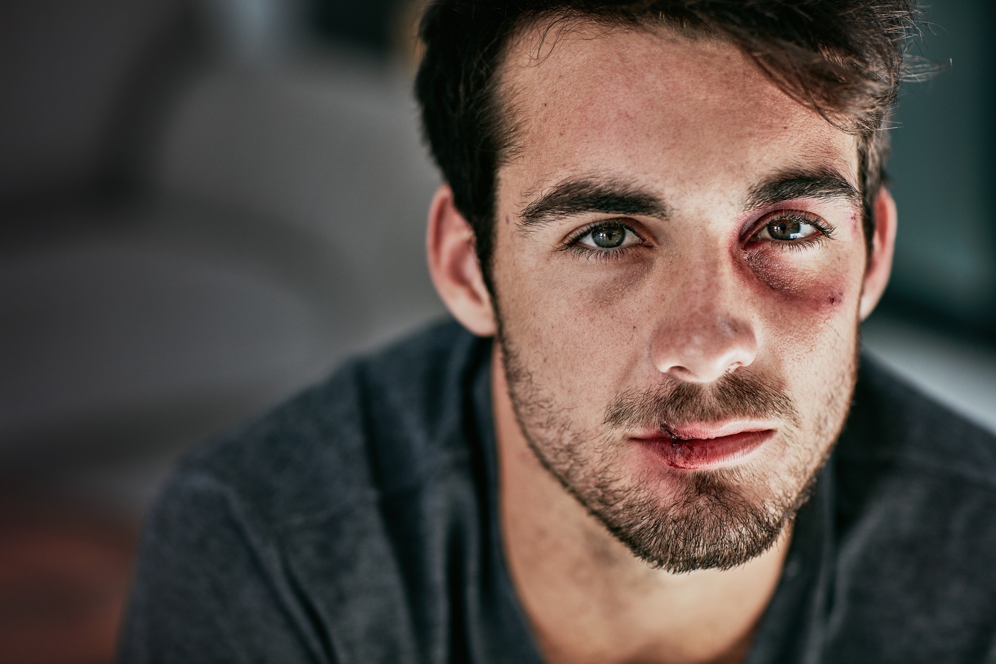 Cropped portrait of a beaten and bruised young man looking down
